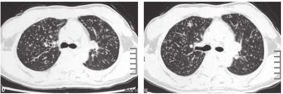 图13 亚急性血行播散型肺结核胸部CT表现.jpg